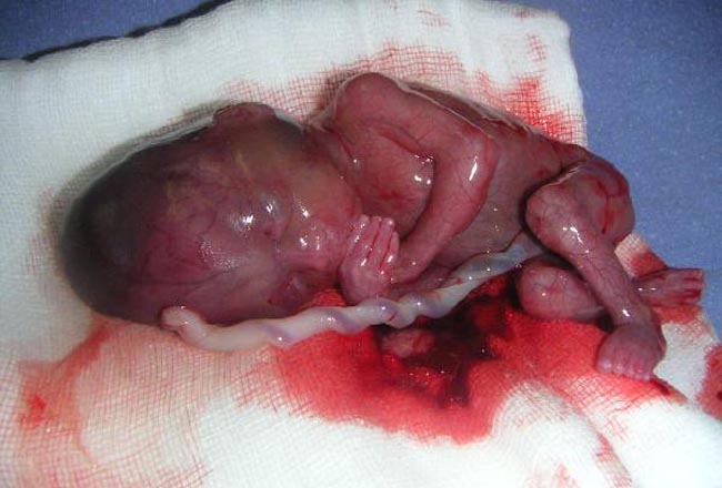 bebe-aborto
